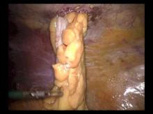 Embedded thumbnail for dr hauters - prévention d&amp;#039;une hernie parastomiale