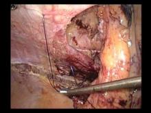 Embedded thumbnail for dr hauters - cure de hernie parastomiale